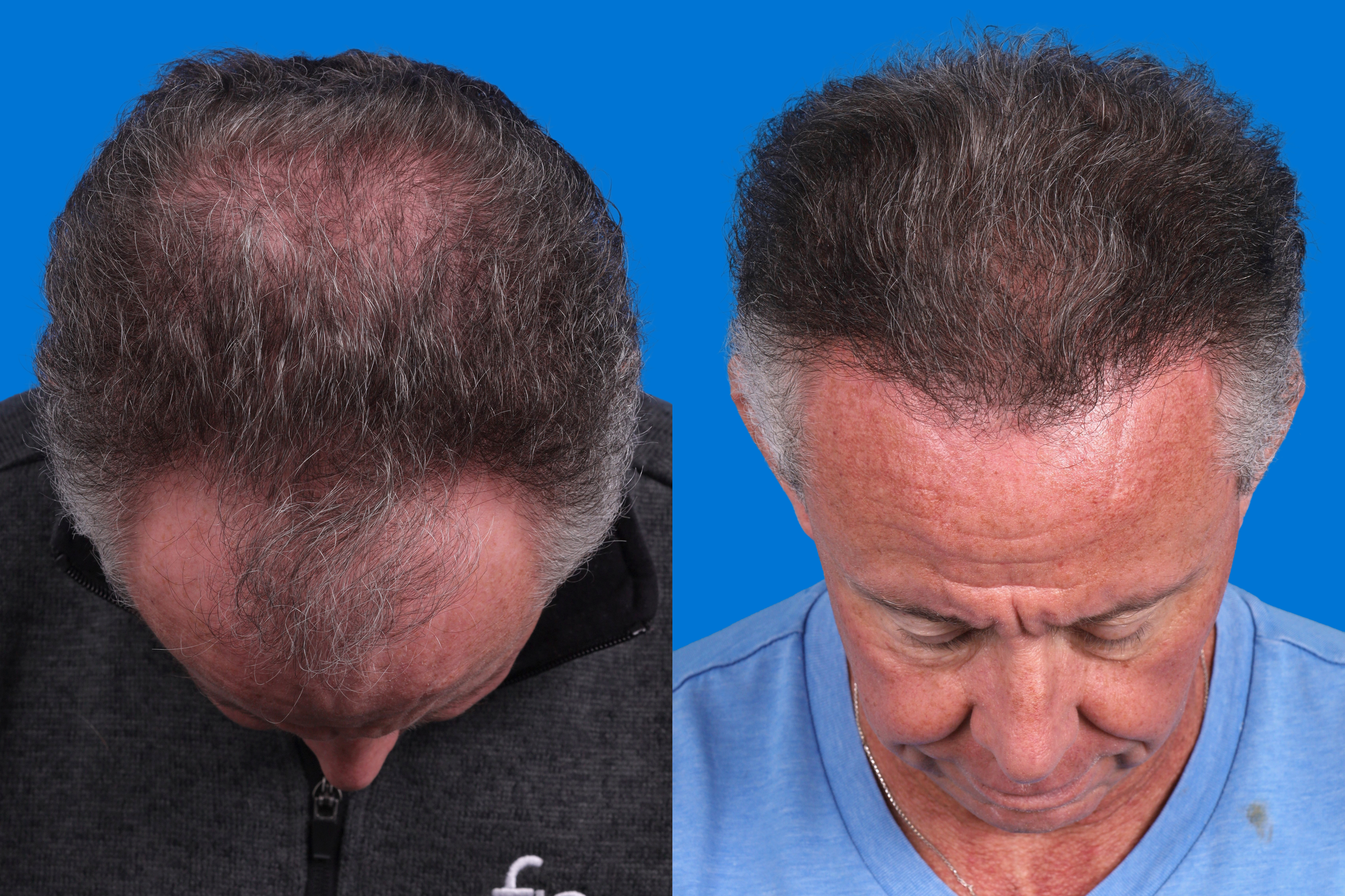 Hair Restoration Before & After Gallery - Patient 169556 - Image 6