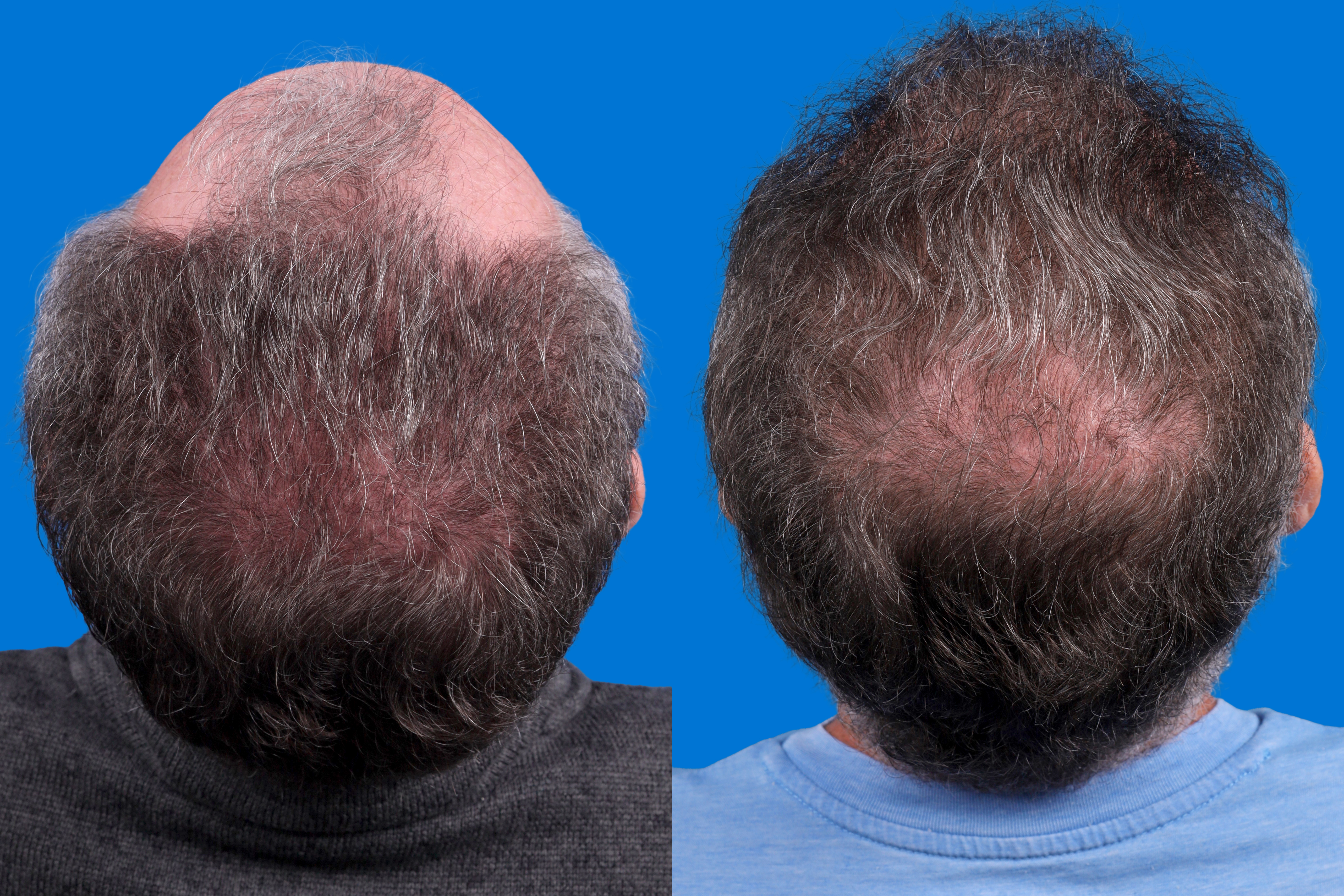Hair Restoration Before & After Gallery - Patient 169556 - Image 7