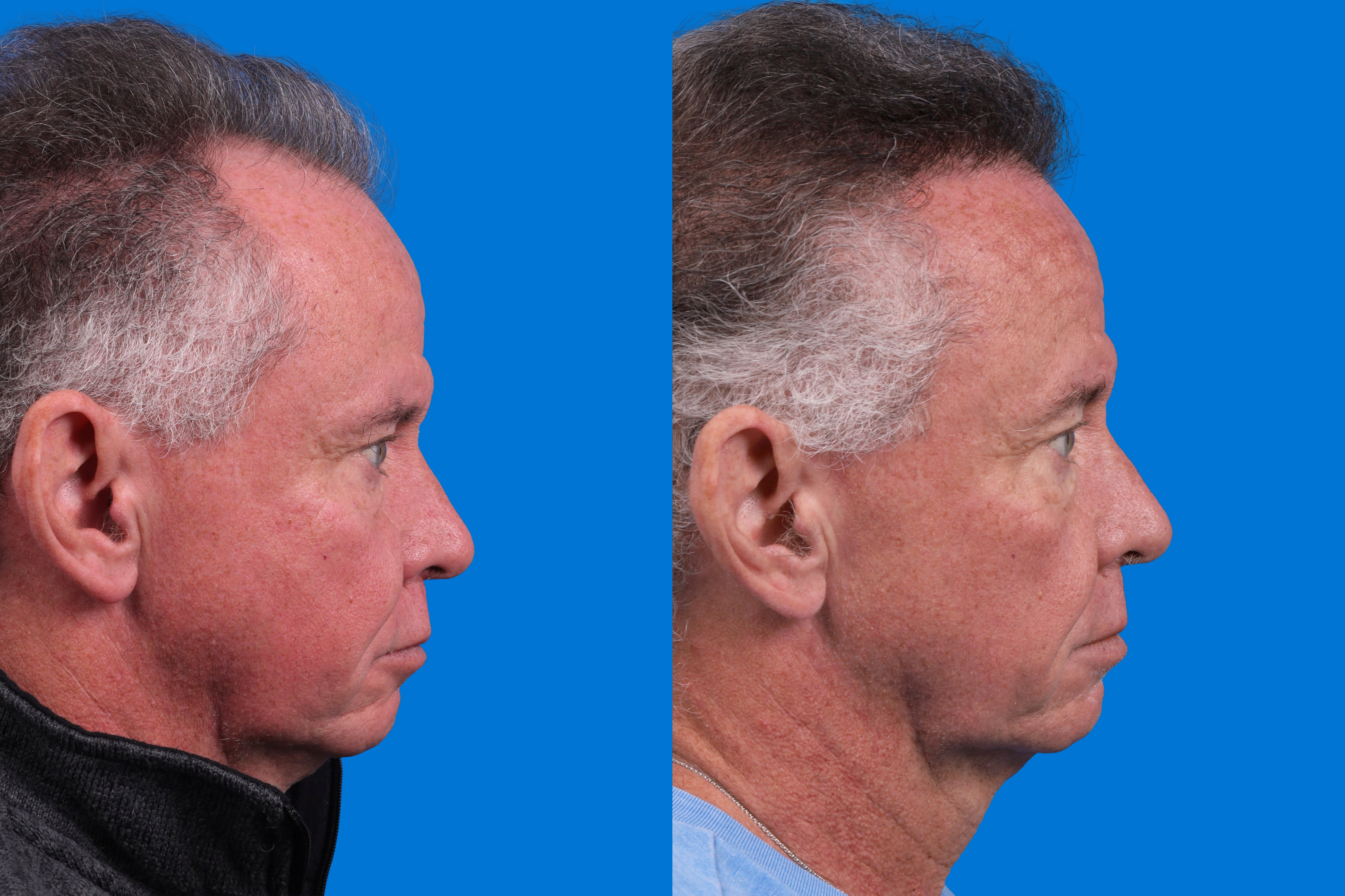 Hair Restoration Before & After Gallery - Patient 169556 - Image 3