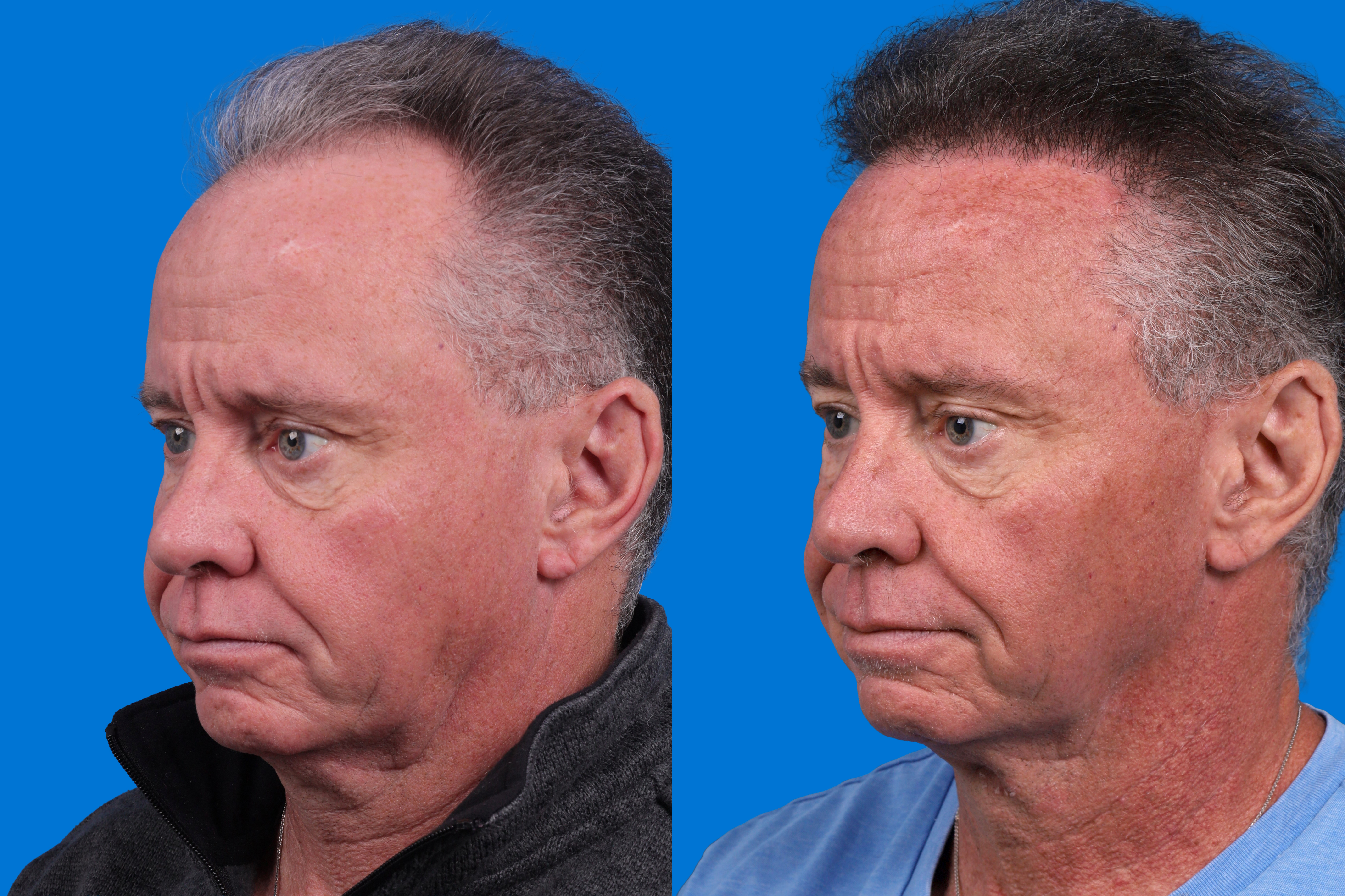 Hair Restoration Before & After Gallery - Patient 169556 - Image 4