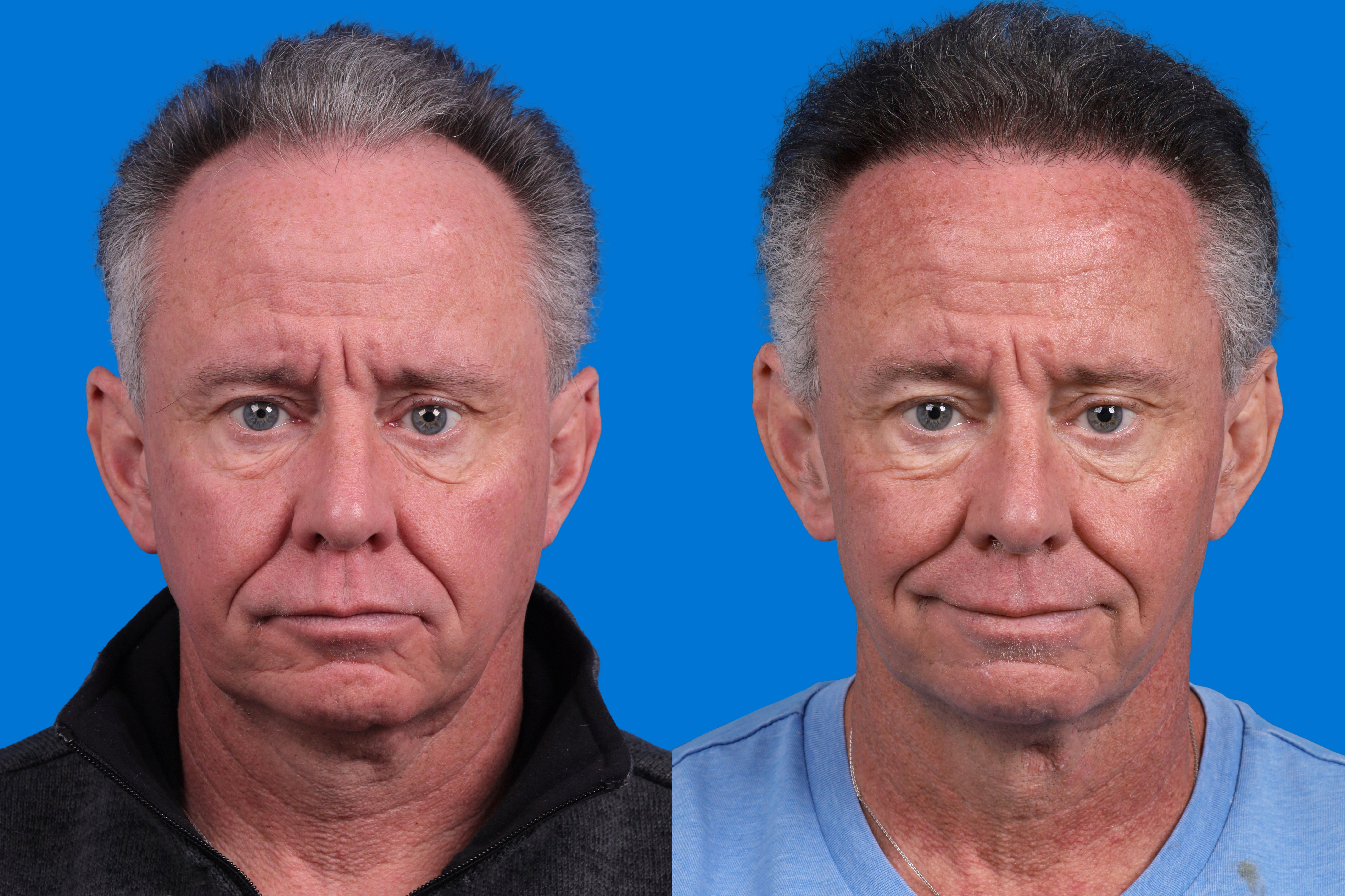 Hair Restoration Before & After Gallery - Patient 169556 - Image 1