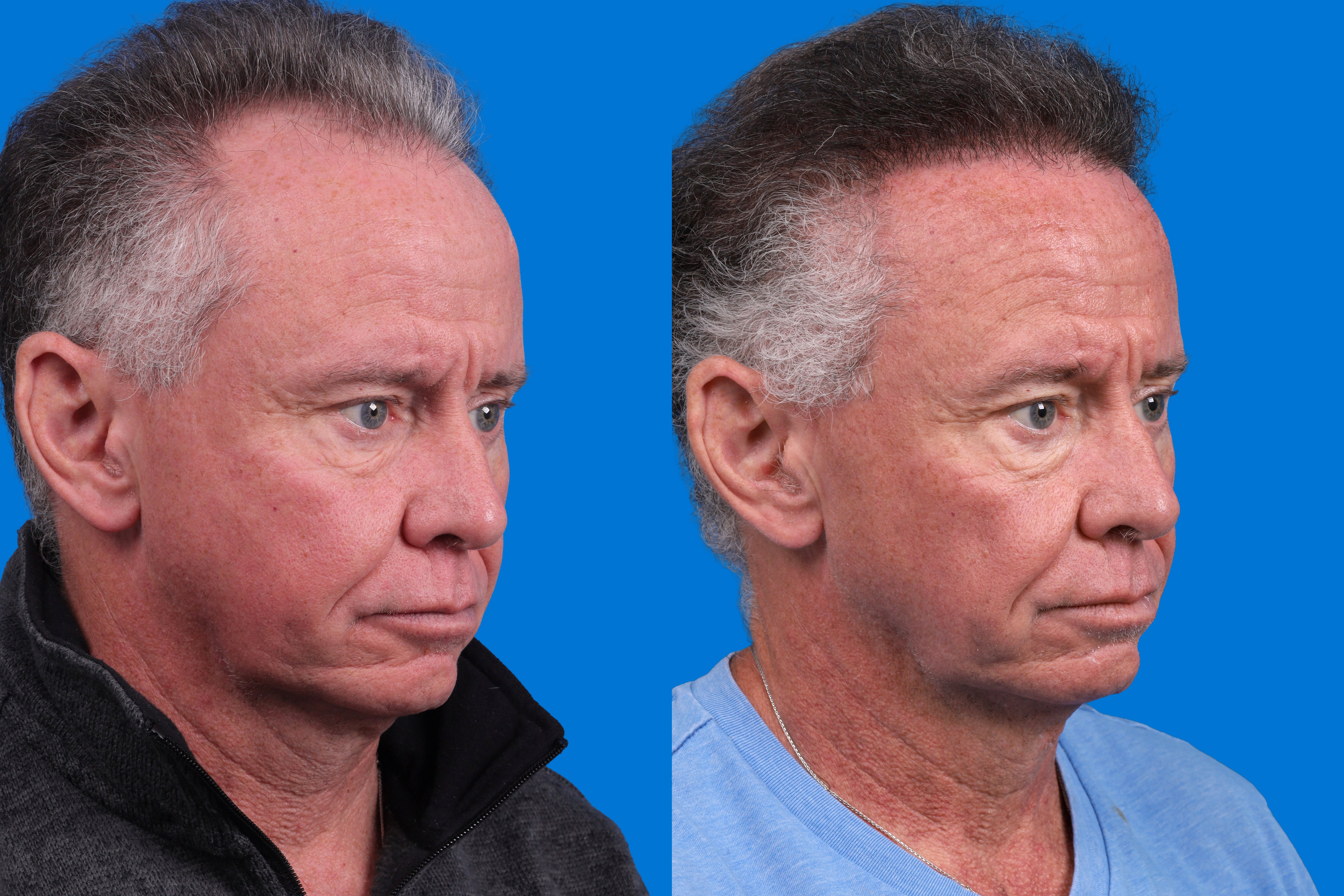 Hair Restoration Before & After Gallery - Patient 169556 - Image 2