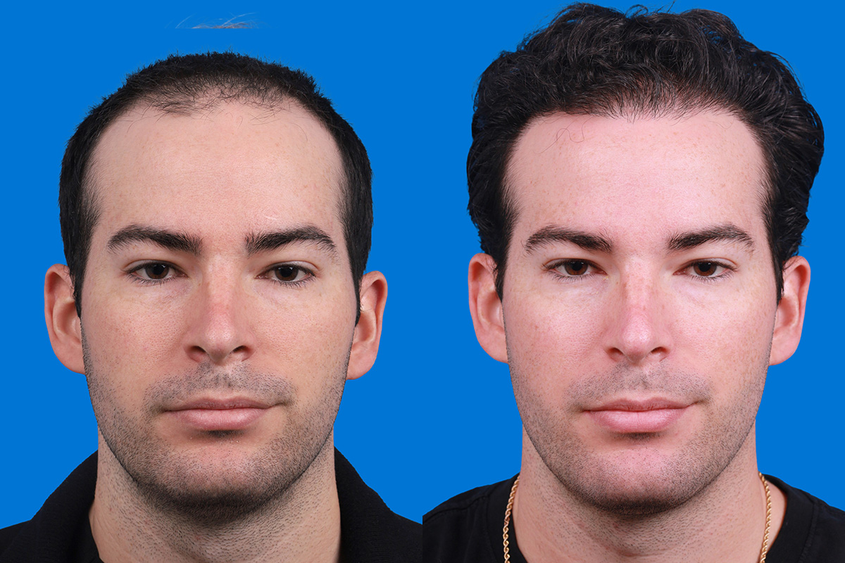Hair Restoration Before & After Gallery - Patient 377984 - Image 1