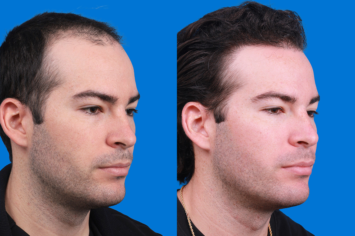 Hair Restoration Before & After Gallery - Patient 377984 - Image 2