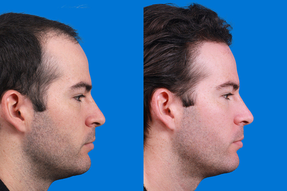 Hair Restoration Before & After Gallery - Patient 377984 - Image 3