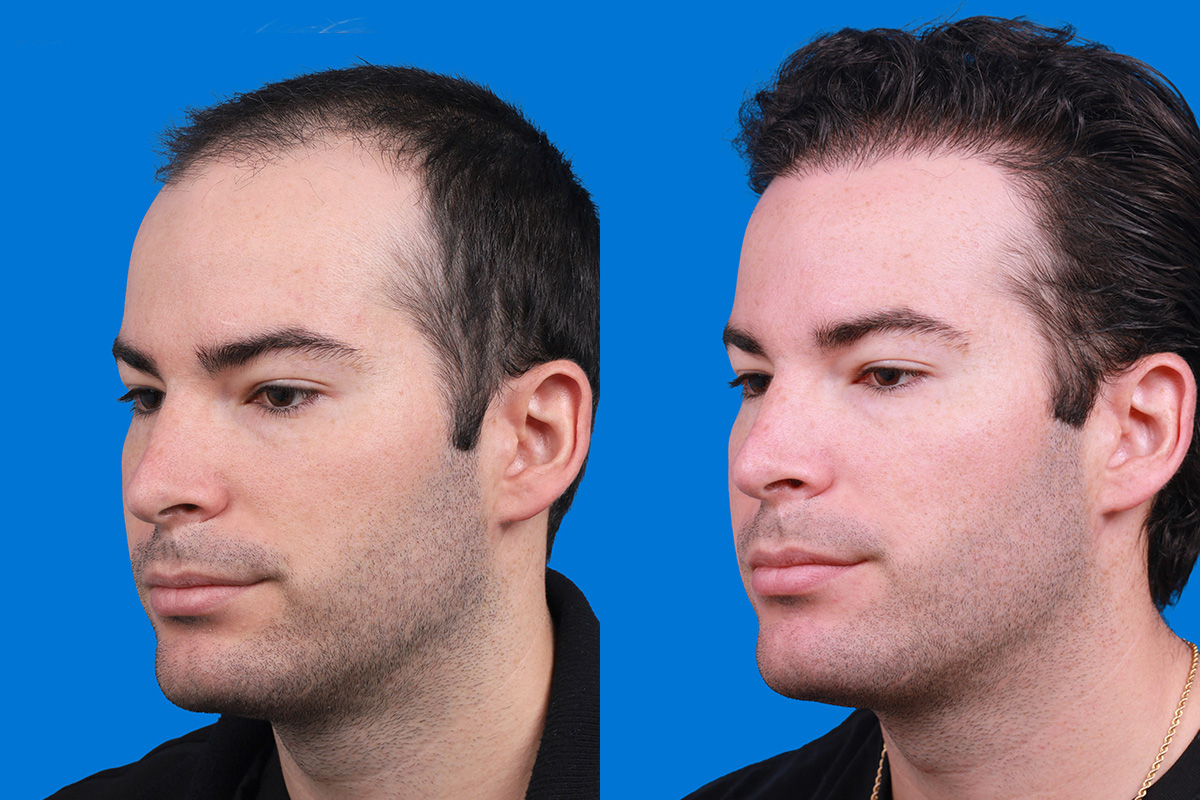 Hair Restoration Before & After Gallery - Patient 377984 - Image 4