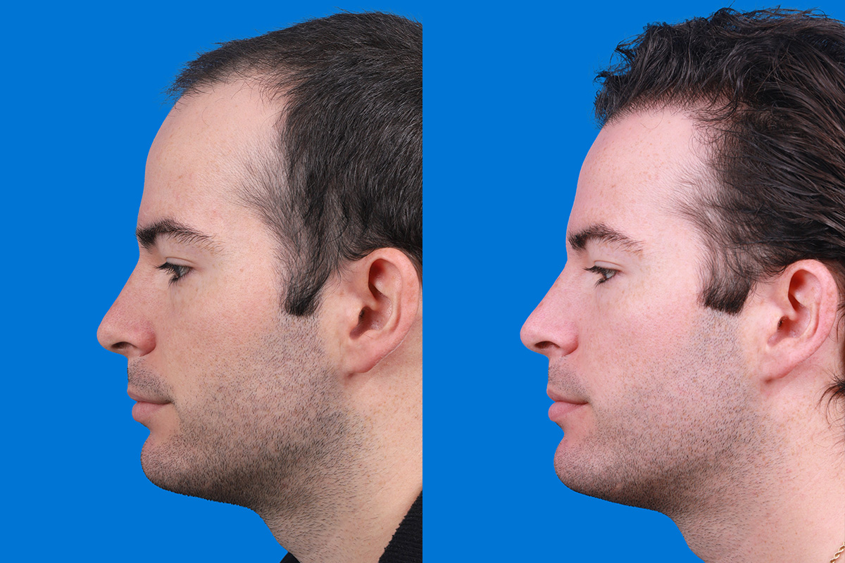 Hair Restoration Before & After Gallery - Patient 377984 - Image 5