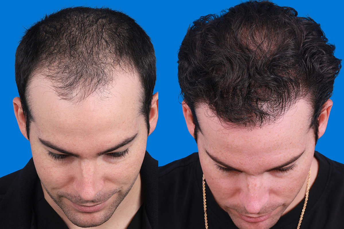 Hair Restoration Before & After Gallery - Patient 377984 - Image 6