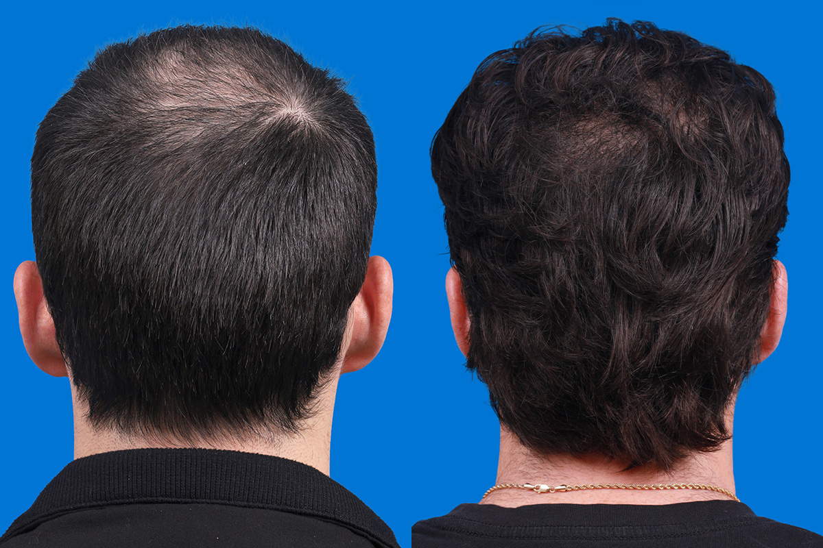 Hair Restoration Before & After Gallery - Patient 377984 - Image 7