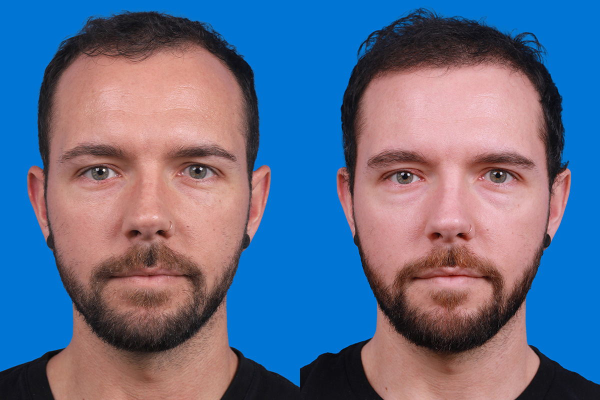 Hair Restoration Before & After Gallery - Patient 218038 - Image 1
