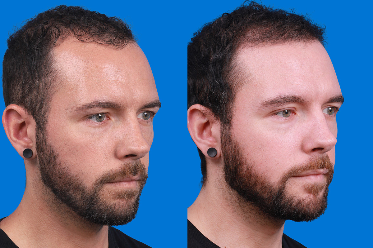 Hair Restoration Before & After Gallery - Patient 218038 - Image 2