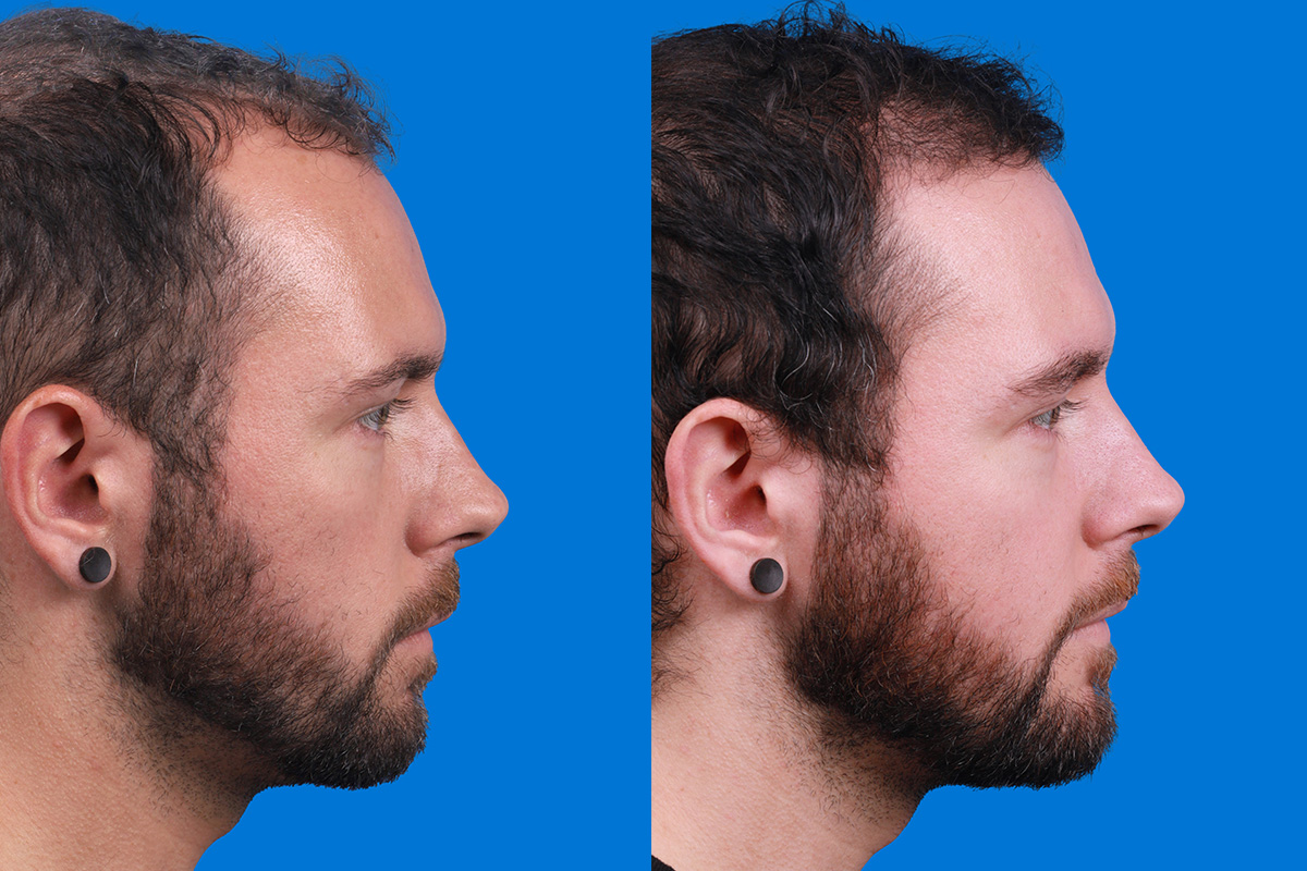 Hair Restoration Before & After Gallery - Patient 218038 - Image 3