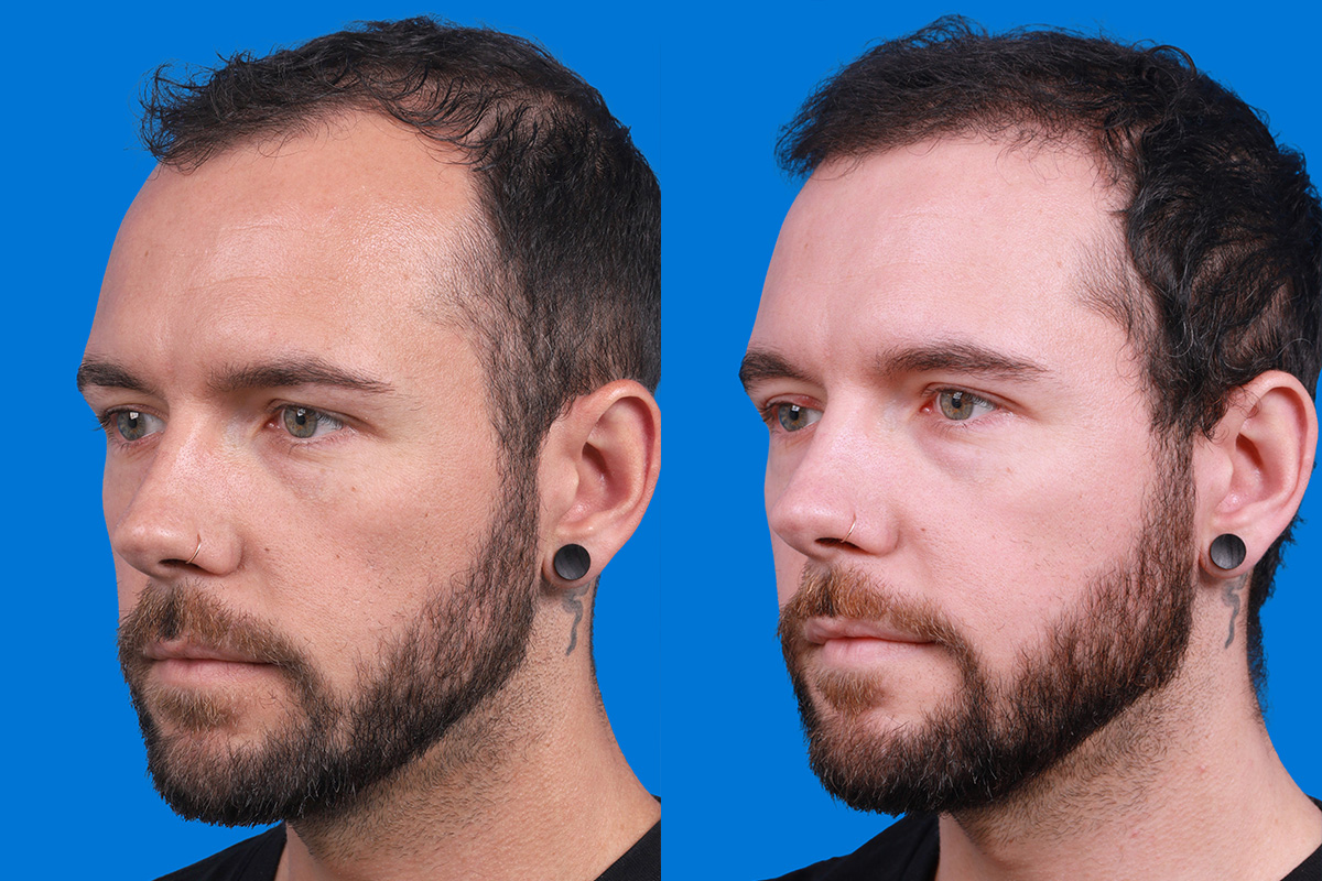 Hair Restoration Before & After Gallery - Patient 218038 - Image 4