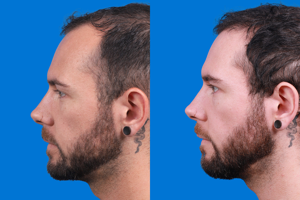 Hair Restoration Before & After Gallery - Patient 218038 - Image 5