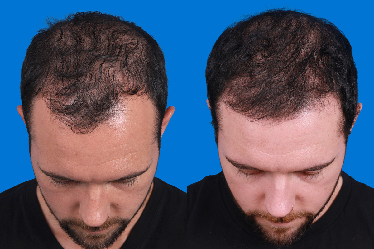 Hair Restoration Before & After Gallery - Patient 218038 - Image 6