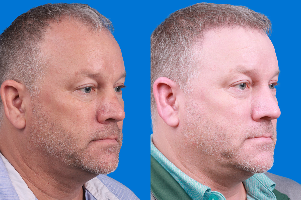 Hair Restoration Before & After Gallery - Patient 417692 - Image 2