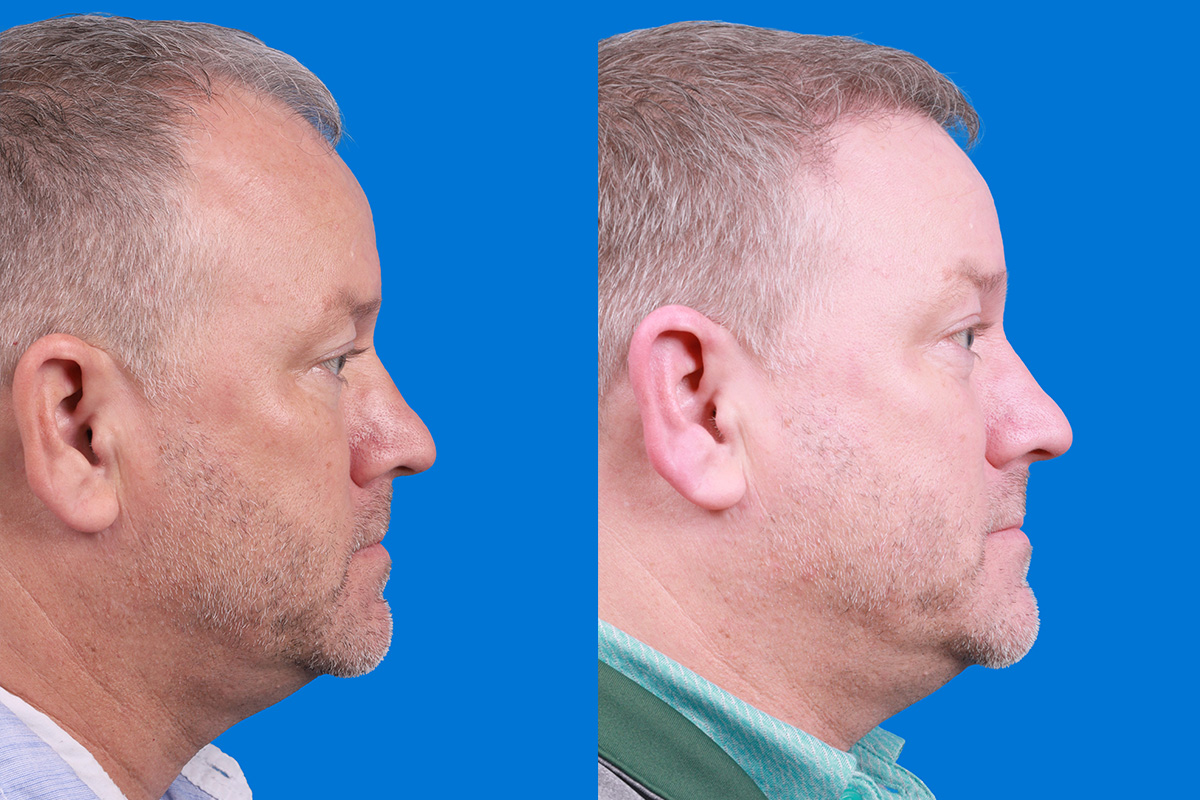 Hair Restoration Before & After Gallery - Patient 417692 - Image 3