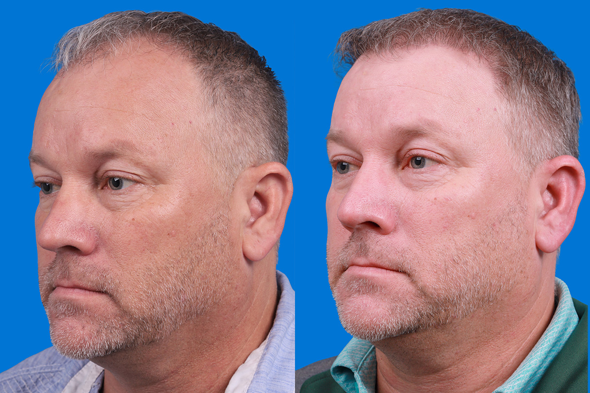 Hair Restoration Before & After Gallery - Patient 417692 - Image 4