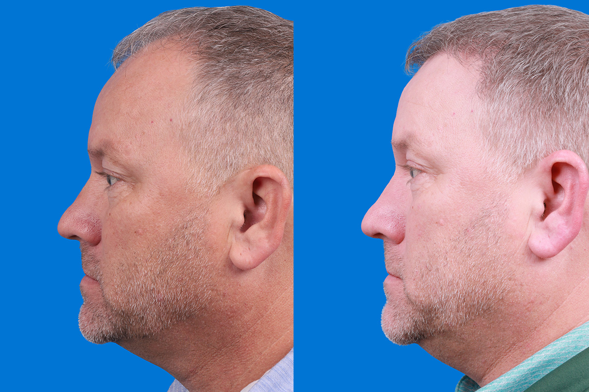 Hair Restoration Before & After Gallery - Patient 417692 - Image 5