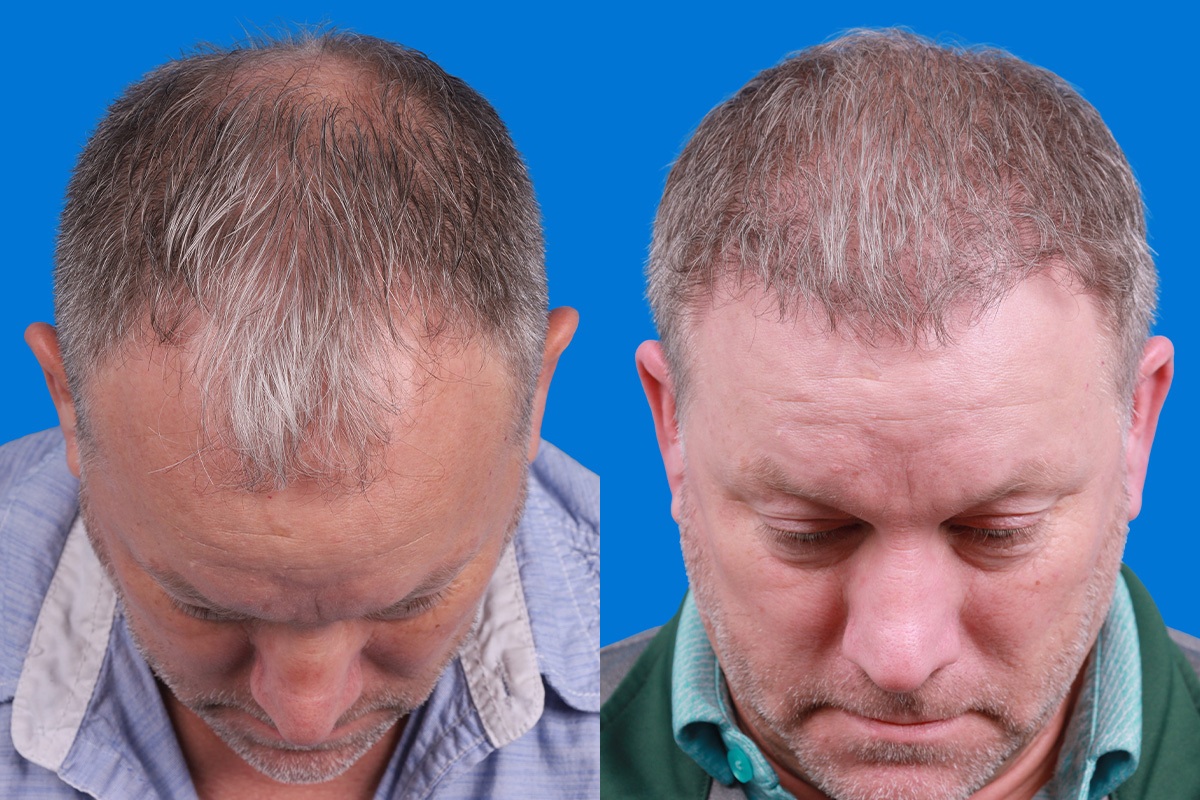 Hair Restoration Before & After Gallery - Patient 417692 - Image 6