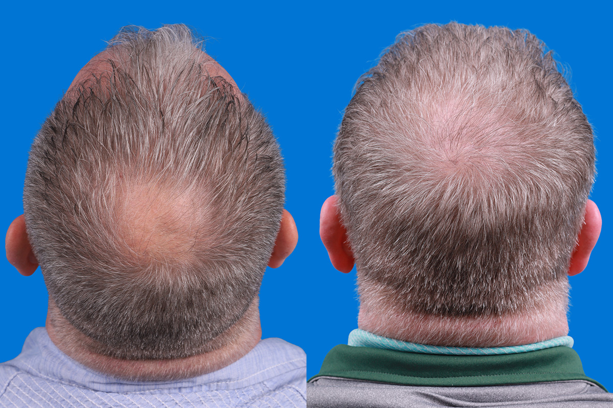 Hair Restoration Before & After Gallery - Patient 417692 - Image 7