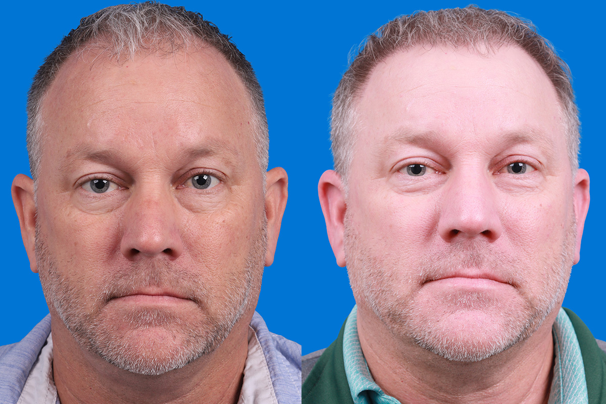 Hair Restoration Before & After Gallery - Patient 417692 - Image 1