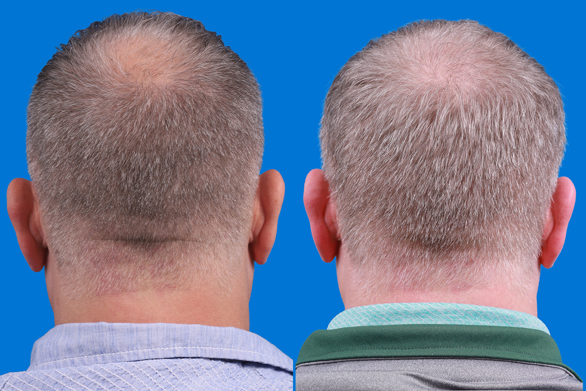 Hair Restoration Before & After Gallery - Patient 417692 - Image 8