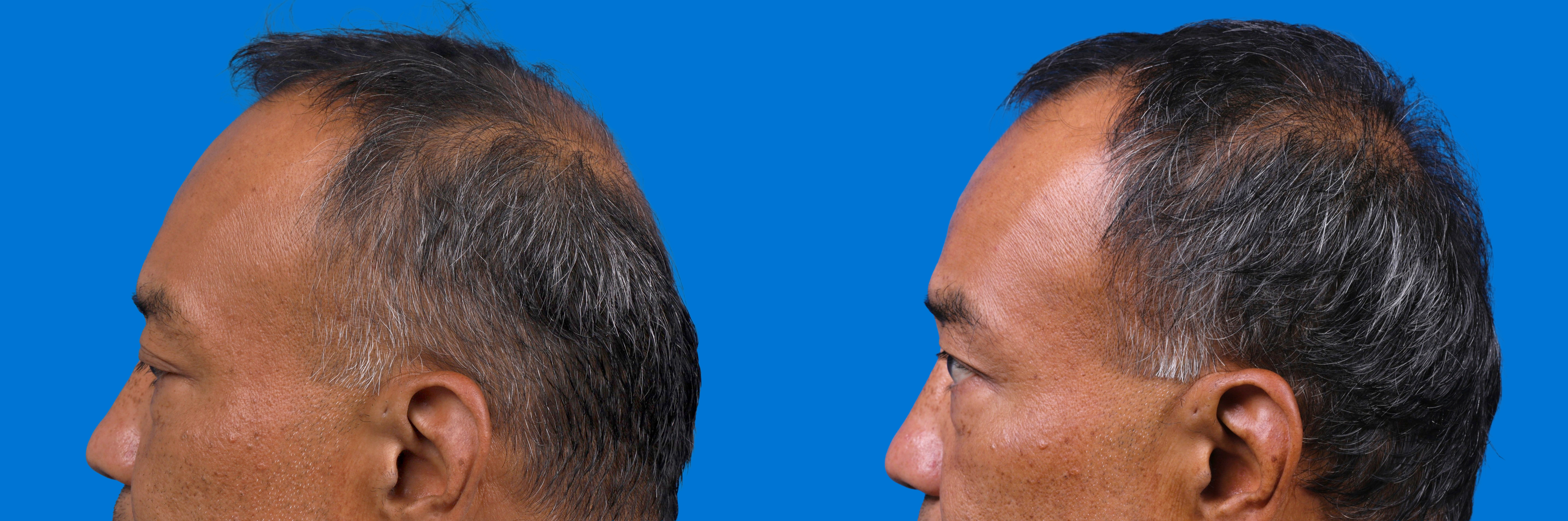 Hair Restoration Before & After Gallery - Patient 939796 - Image 5