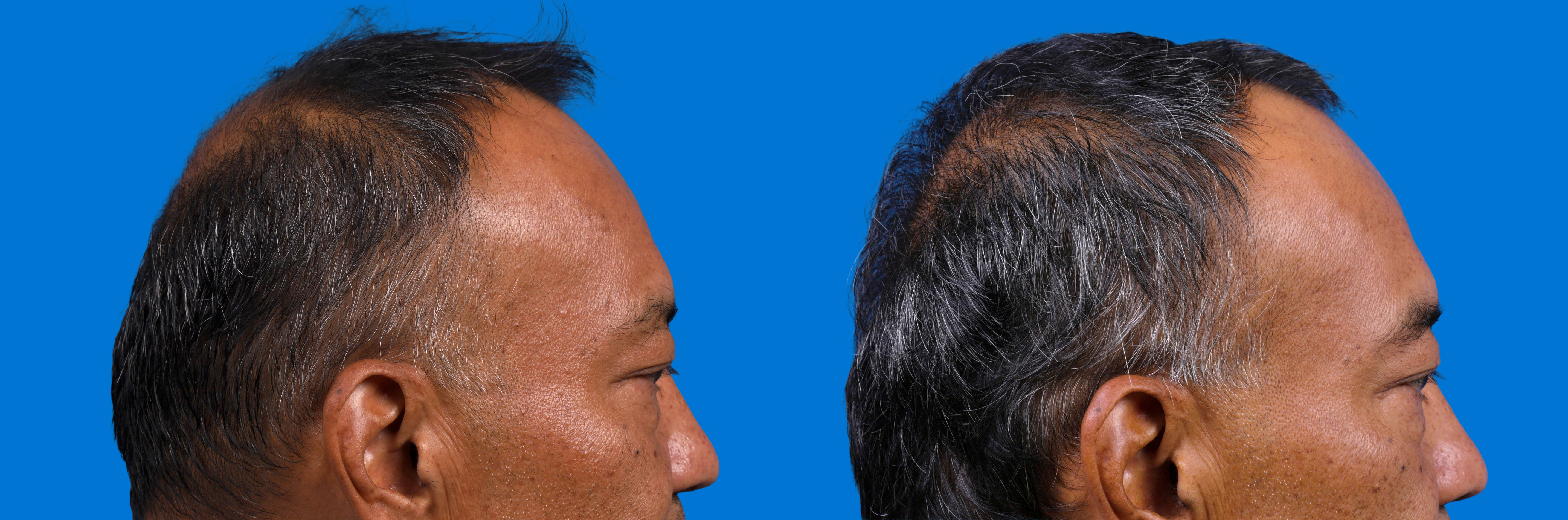 Hair Restoration Before & After Gallery - Patient 939796 - Image 4