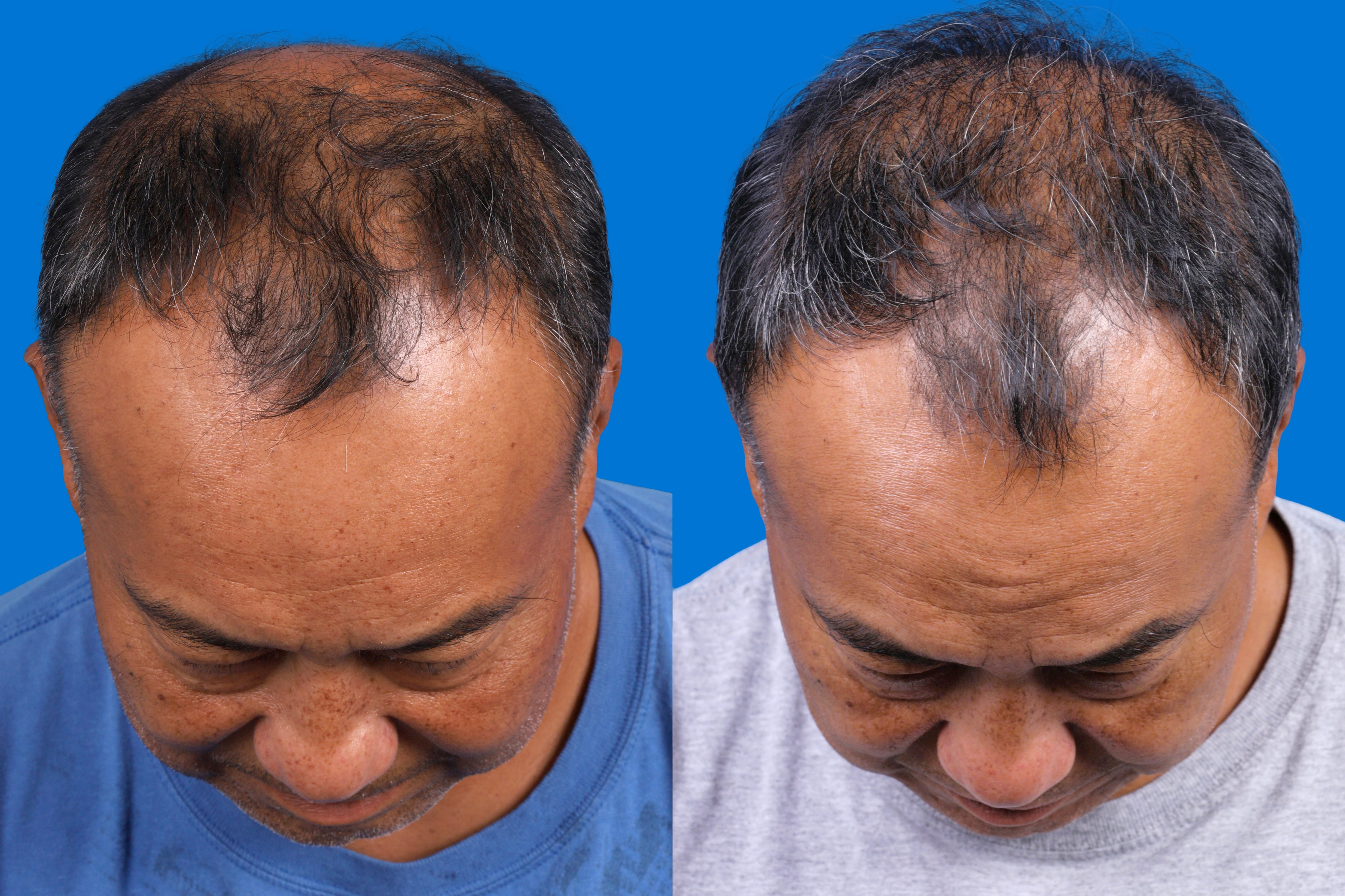 Hair Restoration Before & After Gallery - Patient 939796 - Image 1