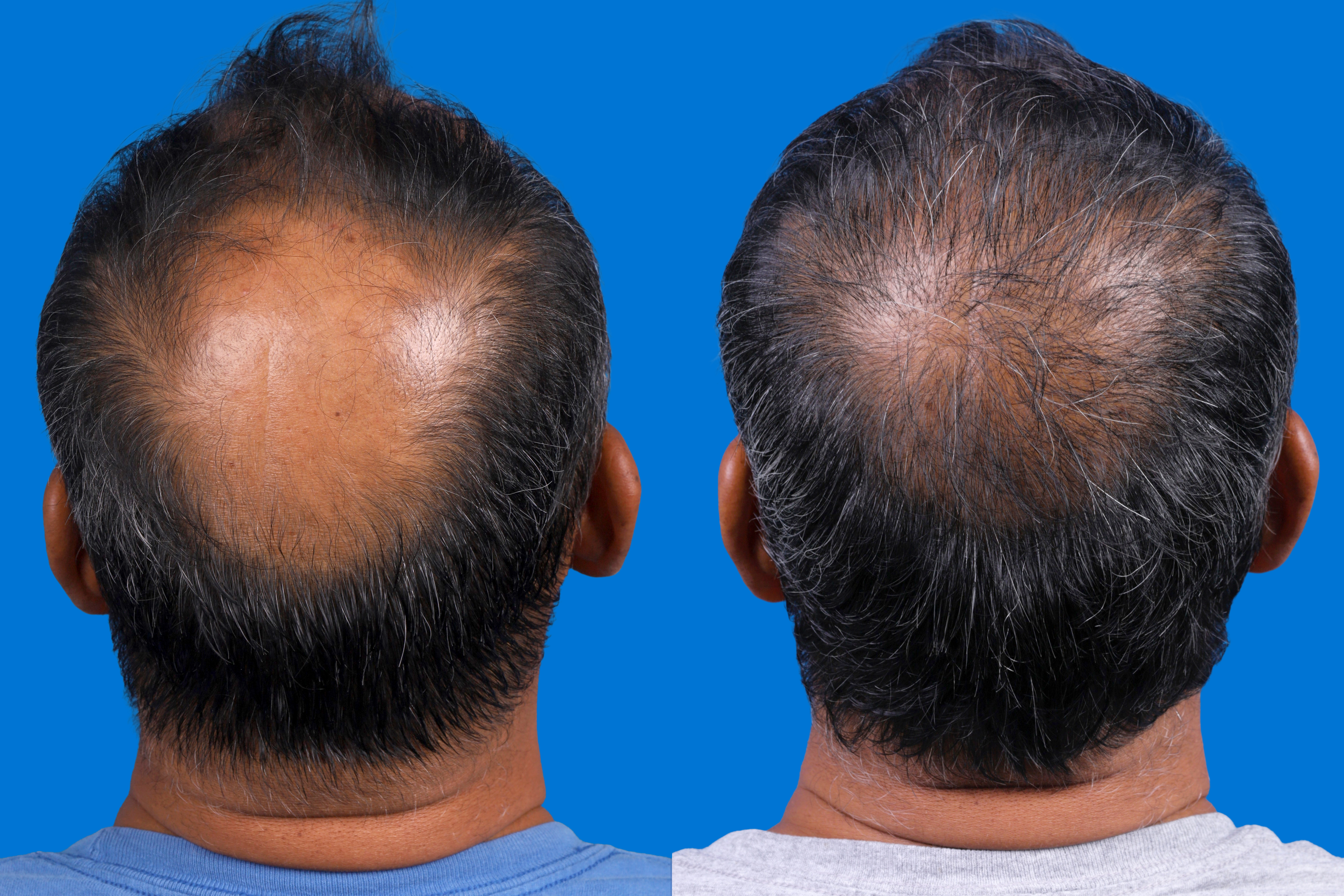 Hair Restoration Before & After Gallery - Patient 939796 - Image 3