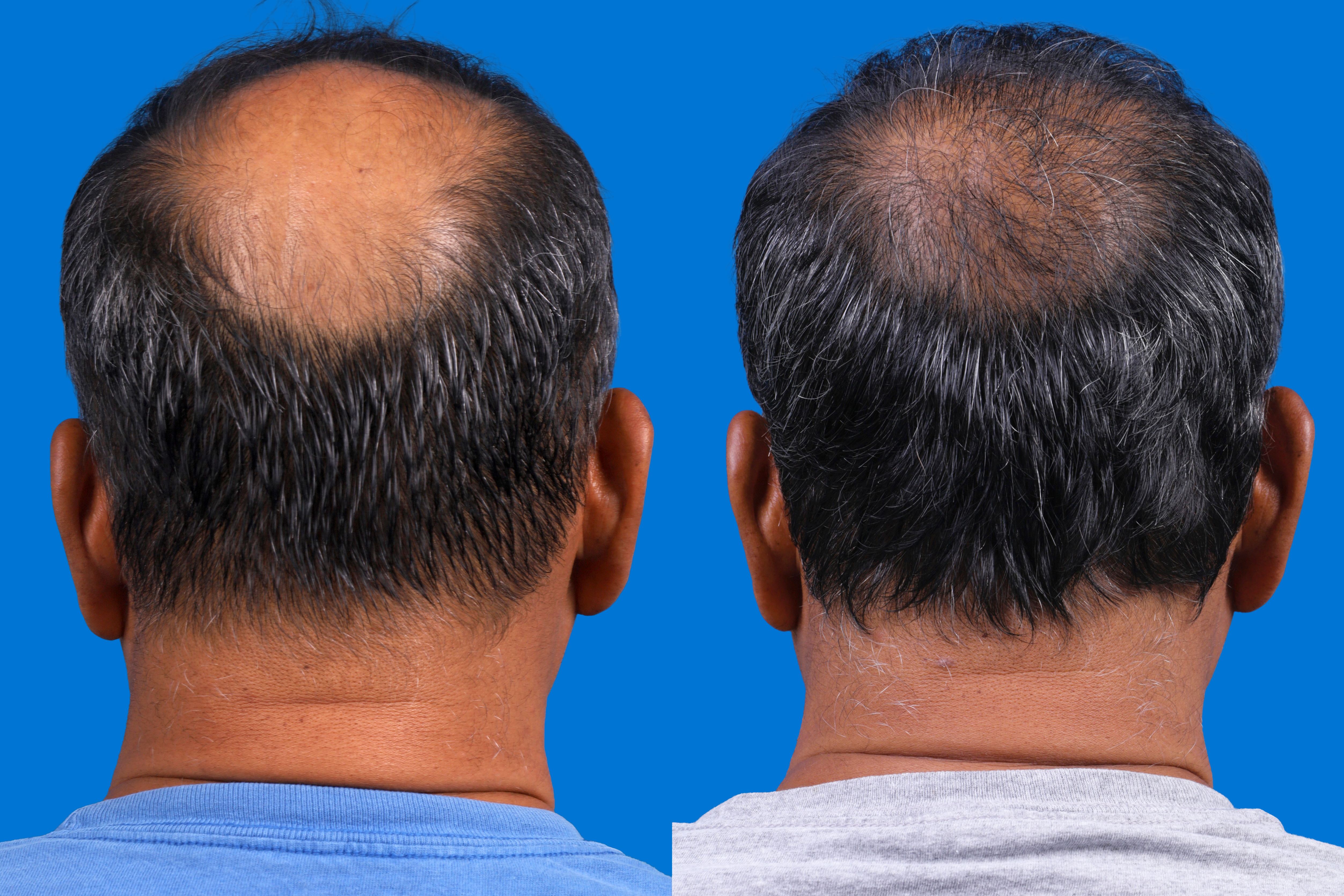 Hair Restoration Before & After Gallery - Patient 939796 - Image 2