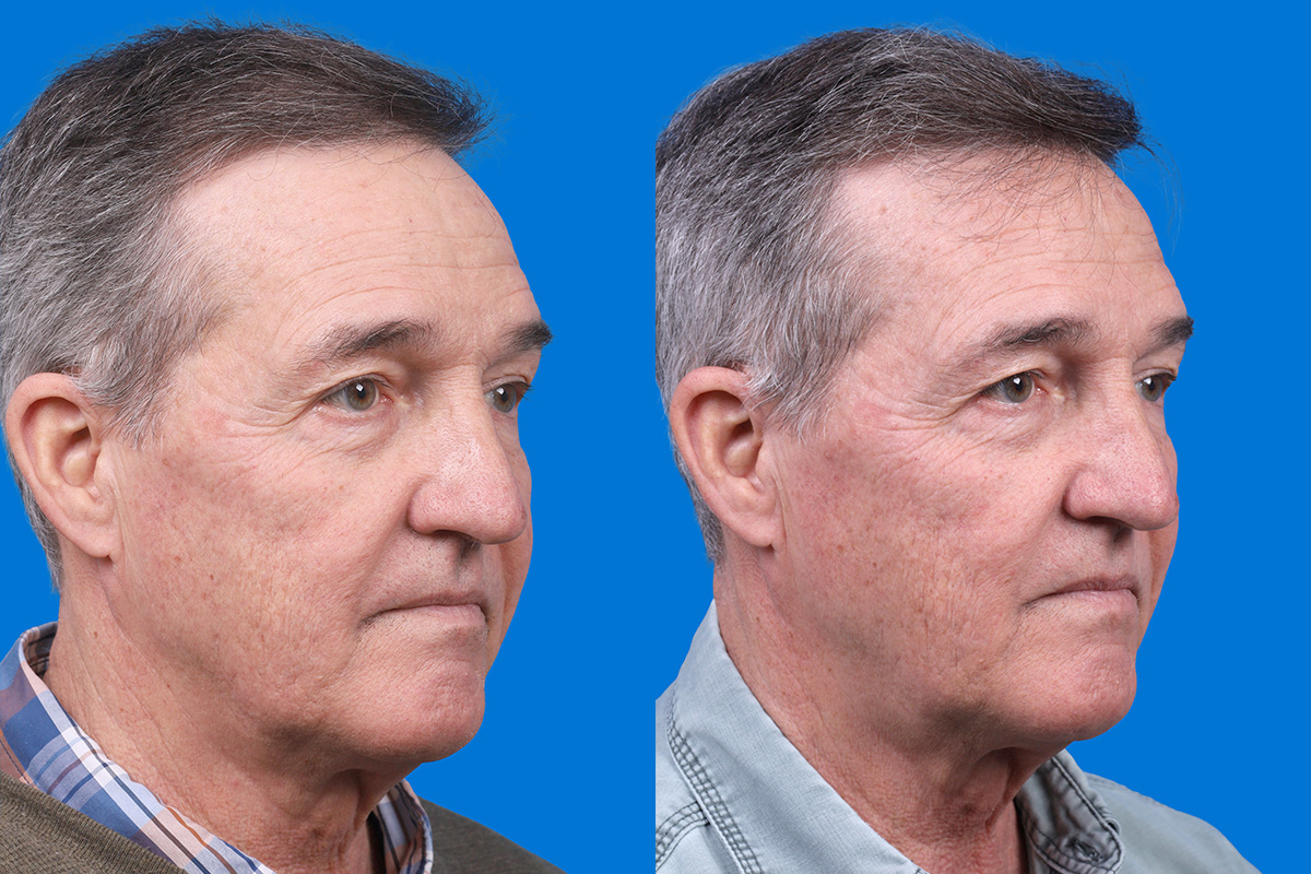 Hair Restoration Before & After Gallery - Patient 194890 - Image 2