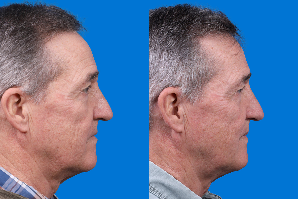 Hair Restoration Before & After Gallery - Patient 194890 - Image 3
