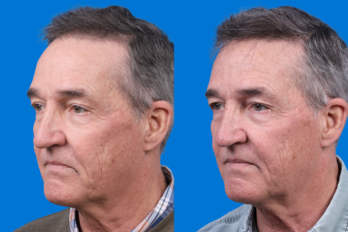 Hair Restoration Before & After Gallery - Patient 194890 - Image 4