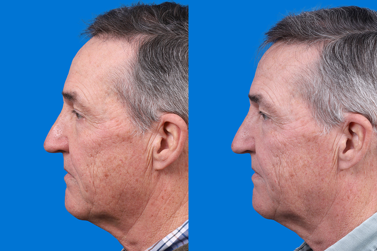 Hair Restoration Before & After Gallery - Patient 194890 - Image 5
