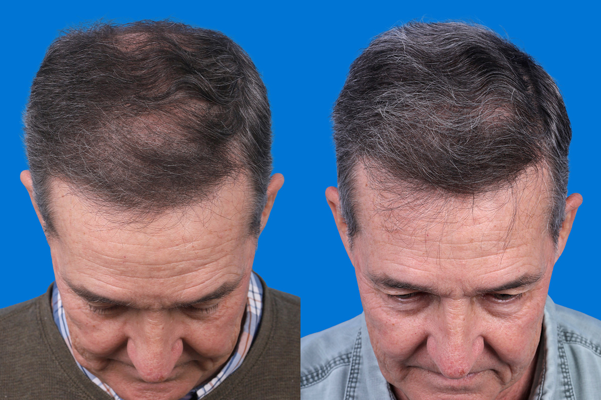 Hair Restoration Before & After Gallery - Patient 194890 - Image 6