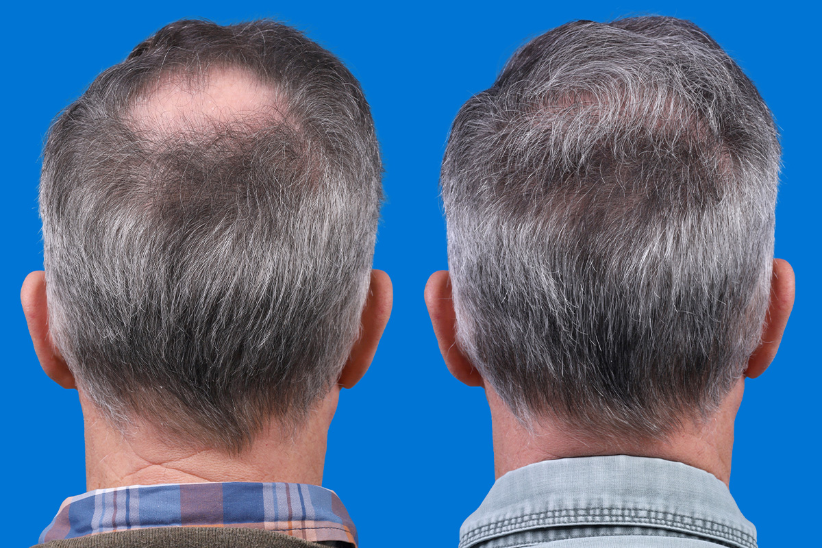 Hair Restoration Before & After Gallery - Patient 194890 - Image 7