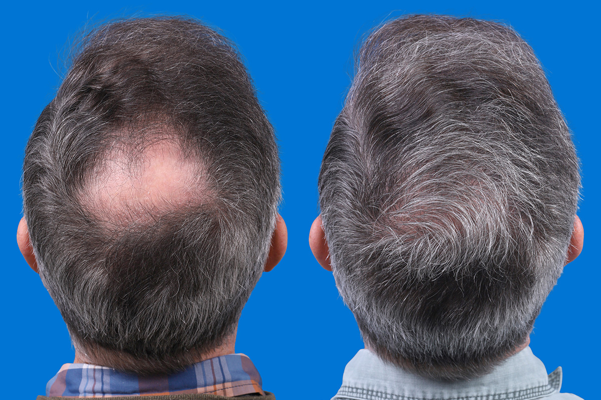 Hair Restoration Before & After Gallery - Patient 194890 - Image 8