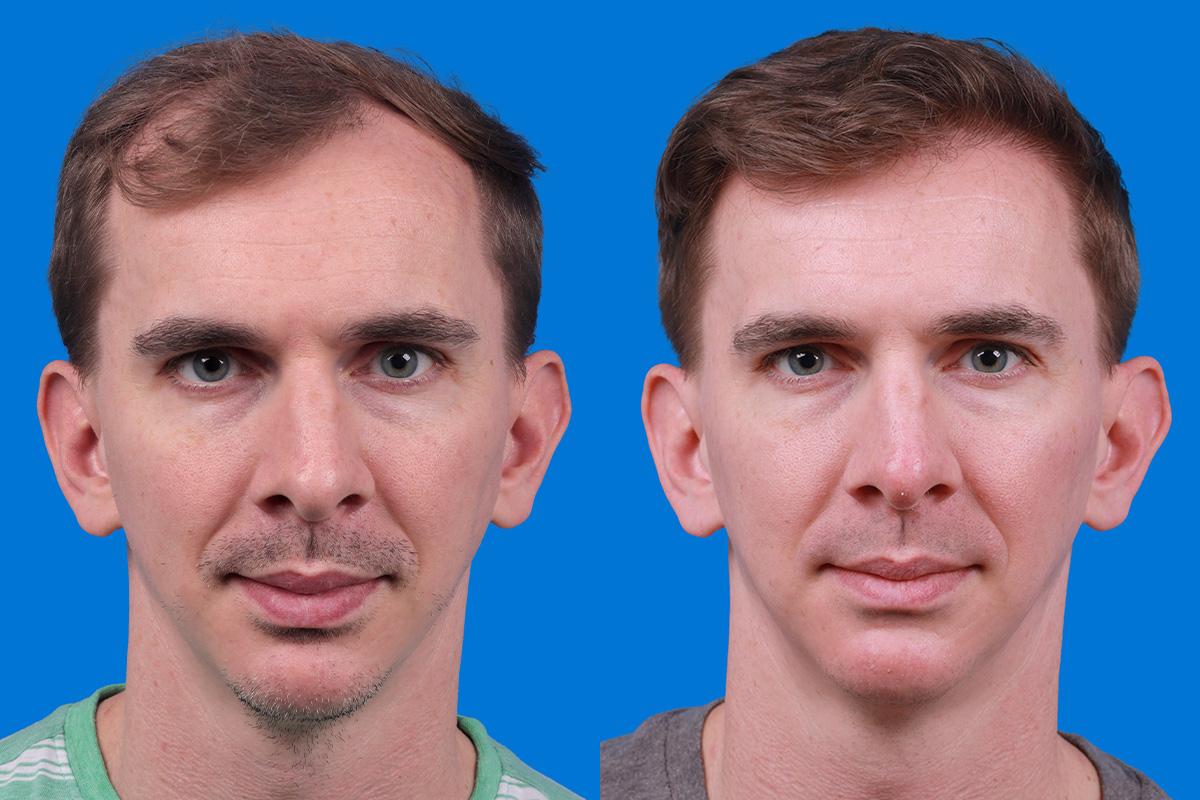 Hair Restoration Before & After Gallery - Patient 148147311 - Image 1