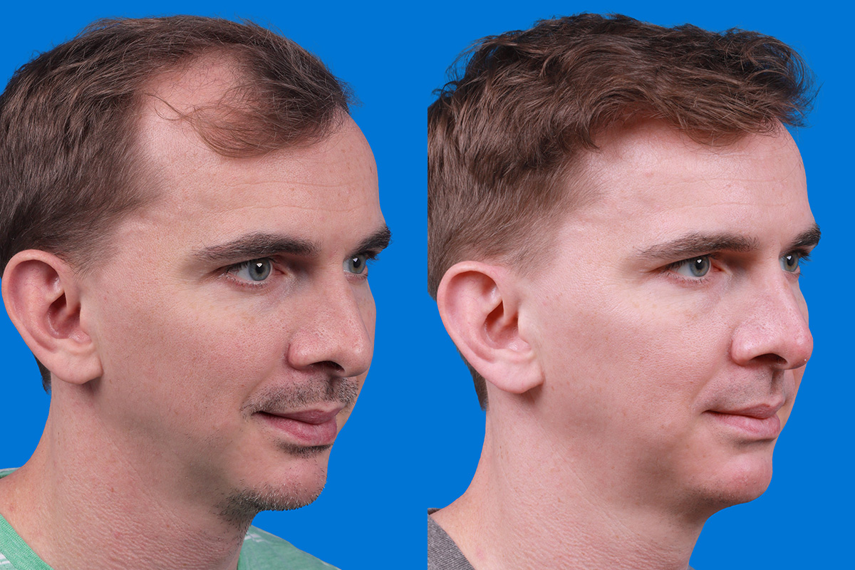 Hair Restoration Before & After Gallery - Patient 148147311 - Image 2