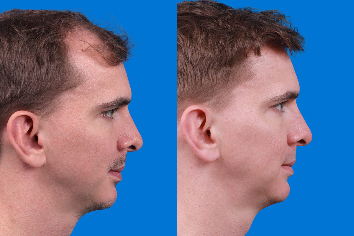 Hair Restoration Before & After Gallery - Patient 148147311 - Image 3