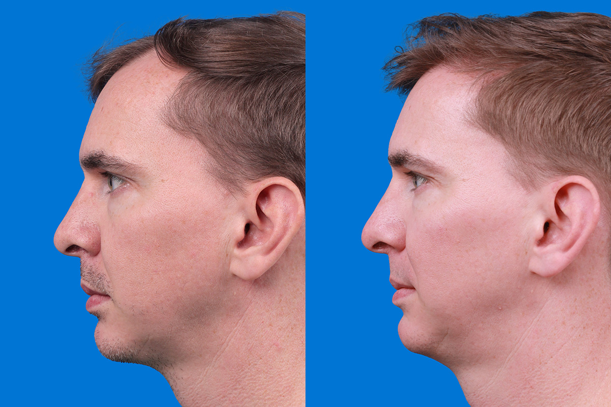 Hair Restoration Before & After Gallery - Patient 148147311 - Image 5