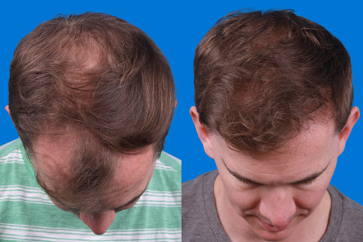 Hair Restoration Before & After Gallery - Patient 148147311 - Image 7