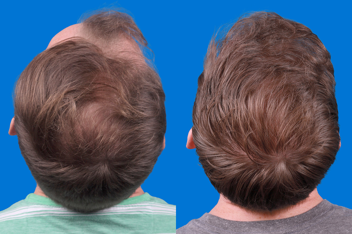 Hair Restoration Before & After Gallery - Patient 148147311 - Image 6