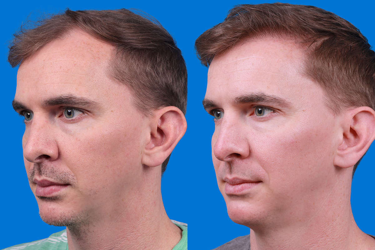 Hair Restoration Before & After Gallery - Patient 148147311 - Image 4