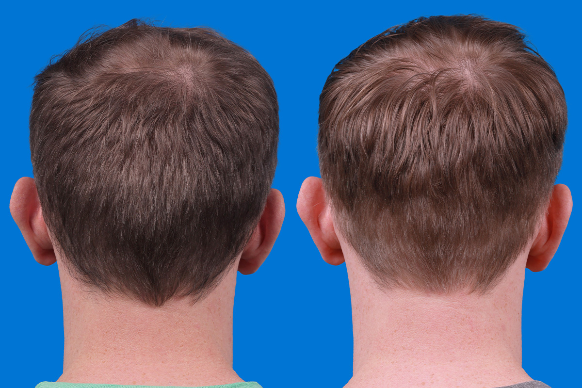 Hair Restoration Before & After Gallery - Patient 148147311 - Image 8