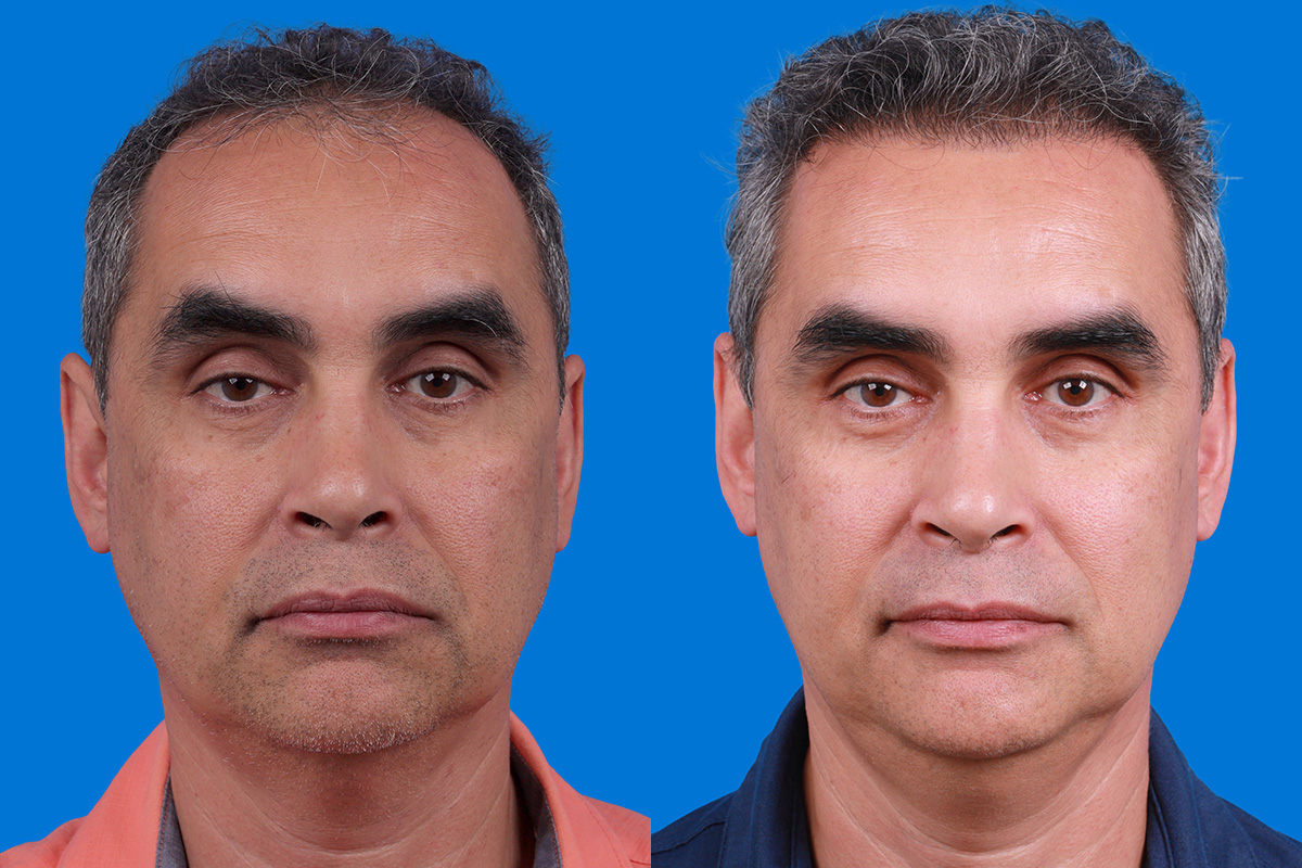Hair Restoration Before & After Gallery - Patient 148467004 - Image 1