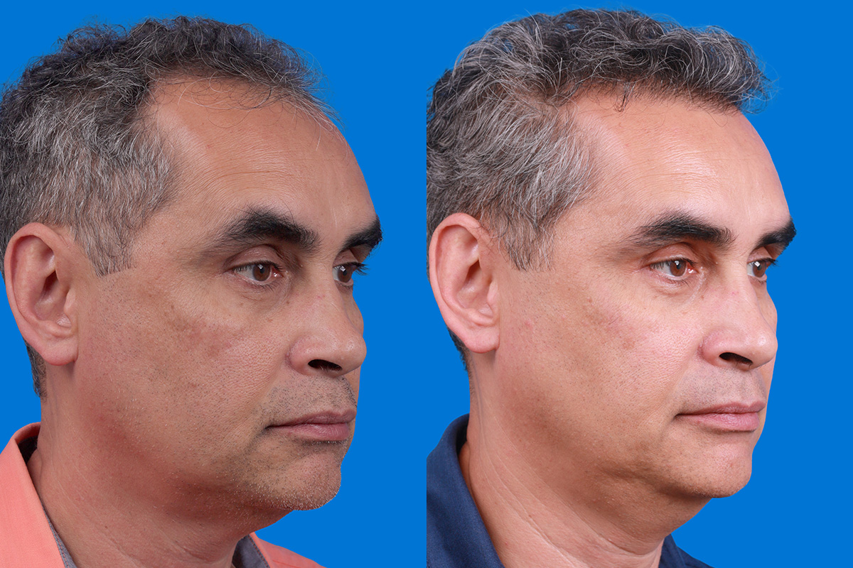 Hair Restoration Before & After Gallery - Patient 148467004 - Image 2