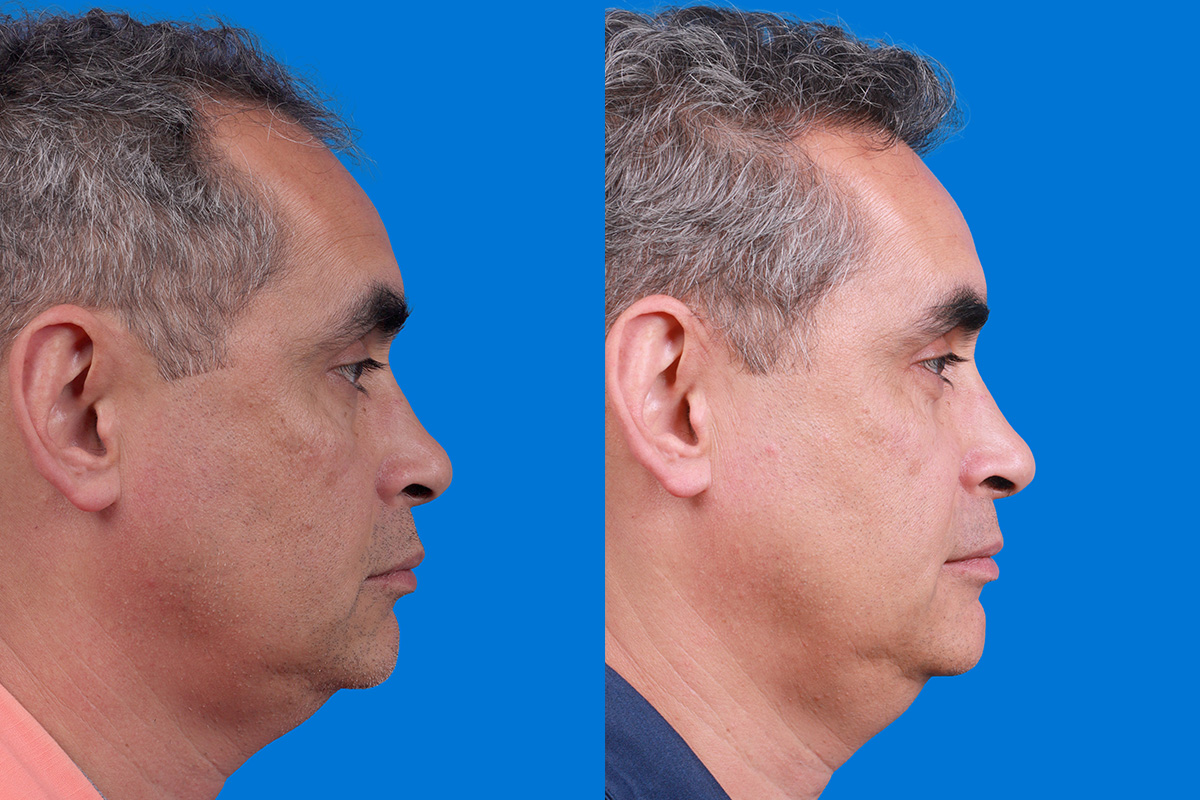Hair Restoration Before & After Gallery - Patient 148467004 - Image 3